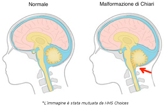 Malformazione di Chiari