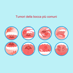 Tumore della bocca