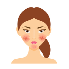 Acne rosacea