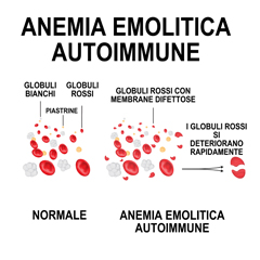 Anemia emolitica autoimmune