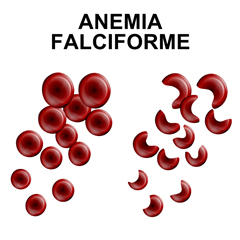 Anemia falciforme