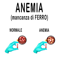 Anemia da carenza di ferro