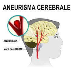 Aneurisma cerebrale