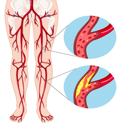 Arteriopatia periferica