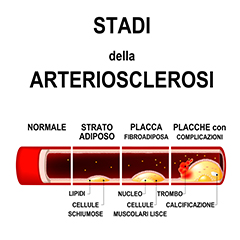 Arteriosclerosi