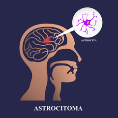 Astrocitoma