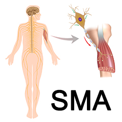 Atrofia muscolare spinale (SMA)