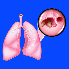 Bronchiectasie