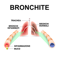 Bronchite