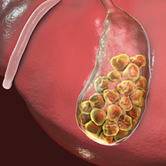 Calcoli della colecisti