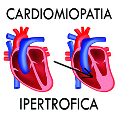 Cardiomiopatia ipertrofica