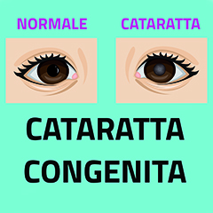 Cataratta congenita