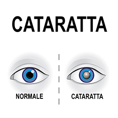 Cataratta