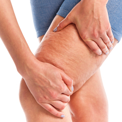 cellulite cosce e glutei