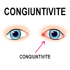 Congiuntivite