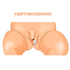 Criptorchidismo