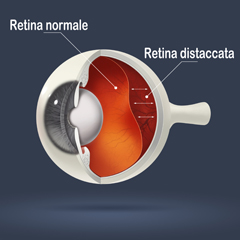 Distacco di retina