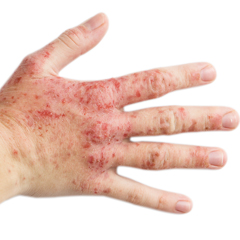 Eczema