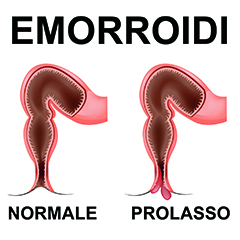 Emorroidi Emorroidi