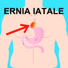 Ernia iatale