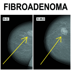 Fibroadenoma mammario