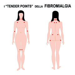 Fibromialgia