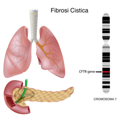 Fibrosi cistica