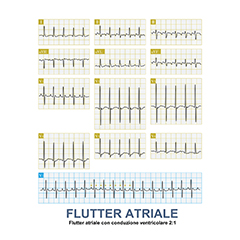 Flutter atriale