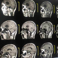 glioblastoma