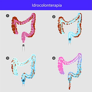 Idrocolonterapia