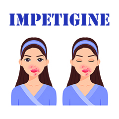 Impetigine