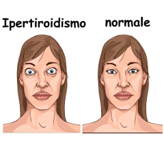 Ipertiroidismo