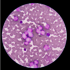 Leucemia mieloide acuta