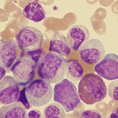 Leucemia mieloide cronica