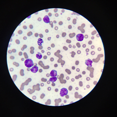 Leucemia linfoblastica acuta