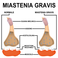 Miastenia gravis