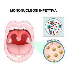 Mononucleosi infettiva