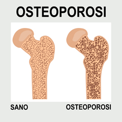 Osteoporosi