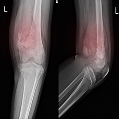 Osteosarcoma