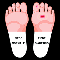 Piede diabetico