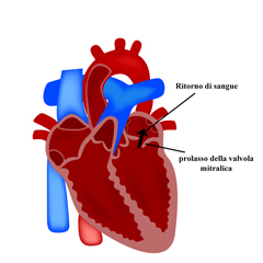 Prolasso della mitrale