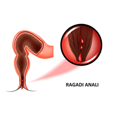 Dilatazione anale nella terapia sintomatica delle emorroidi