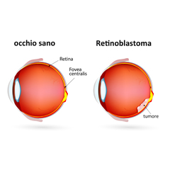 Retinoblastoma