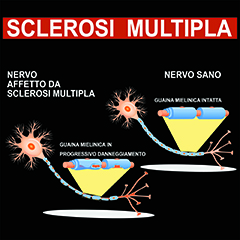 Sclerosi multipla
