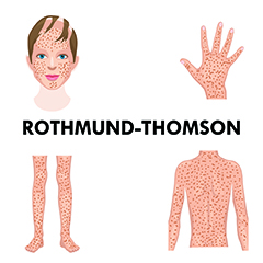 Sindrome di Rothmund-Thomson