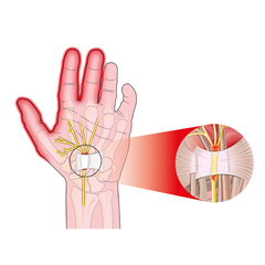 Sindrome del tunnel carpale