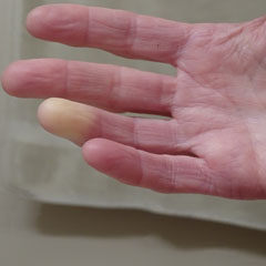 Sindrome o fenomeno di Raynaud