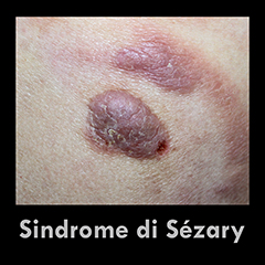 Sindrome di Sézary