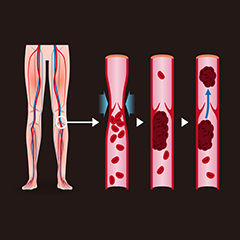 Sindrome antifosfolipidica