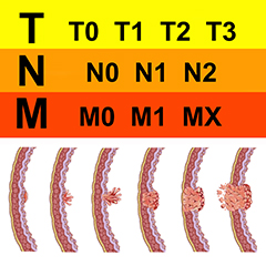 Stadiazione dei tumori